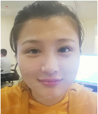 岳阳你美整形医院双眼皮真人案例 图2