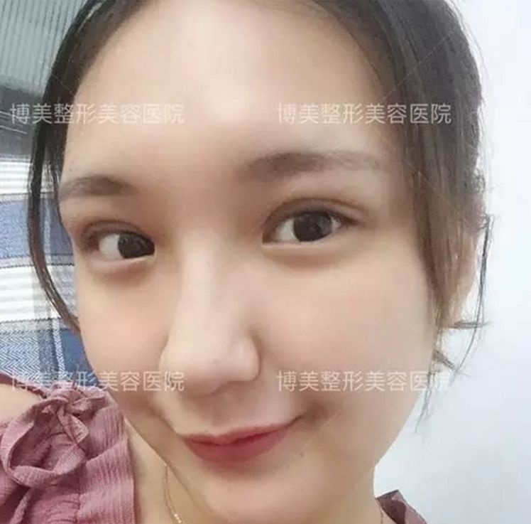 永州博美整形怎么样?永州博美整形做双眼皮怎么样? 图2