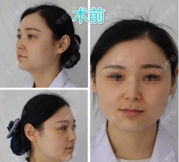 湖北黄石中爱内部员工玻尿酸隆鼻+丰下巴整形经历