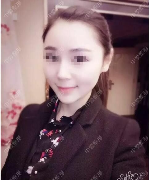 湖北黄石中爱内部员工玻尿酸隆鼻+丰下巴整形经历 图2