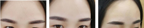 在衡水唯美花3670元做切开双眼皮让我摆脱小眼尴尬