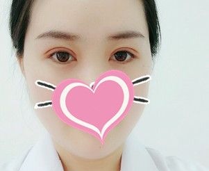在衡水唯美花3670元做切开双眼皮让我摆脱小眼尴尬 图2