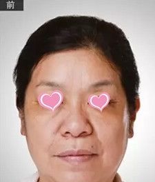 衡水天宏整形医院做埋线提升效果好吗？看真人案例展示