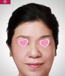 衡水天宏整形医院做埋线提升效果好吗?看真人案例展示 图2
