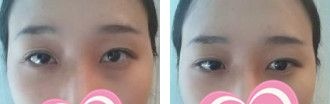 在廊坊华康花4380元做韩式双眼皮后由内双变魅力大眼