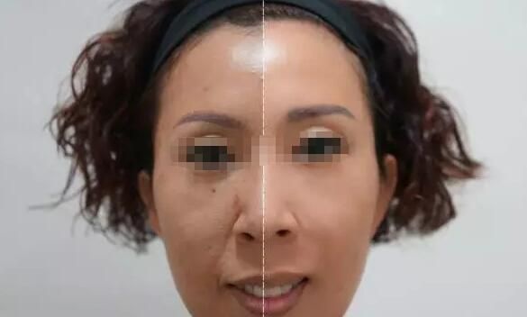 三亚维多利亚乔雅登玻尿酸改善鼻唇沟泪沟蜕变案例 图2