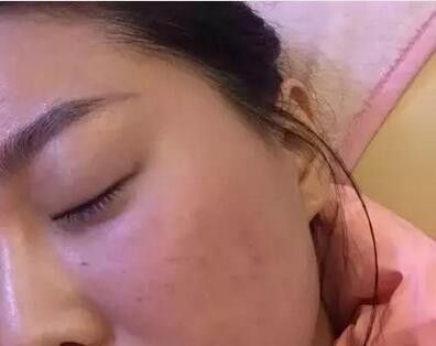 在南阳艾美做了水光注射还一个水嫩嫩的自己