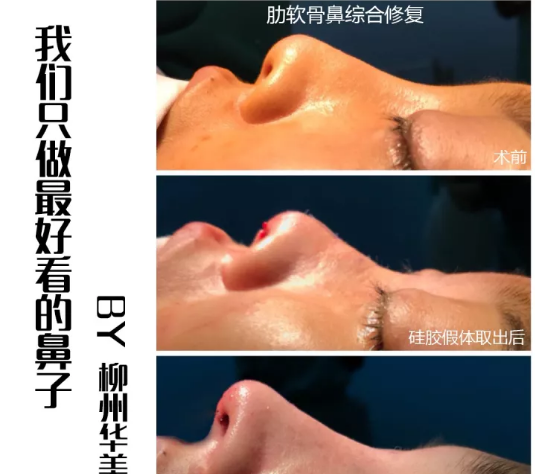 柳州华美隆鼻怎么样?王文院长肋软骨鼻综合修复案例过程大起底 图2