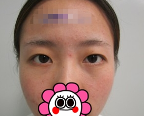 双眼皮恢复日记组图:长治悦美整形1周让我有无痕美眼效果