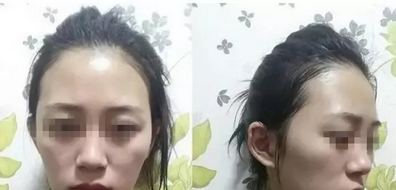 南充华美自体脂肪祛黑眼圈+脂肪填充全面部恢复过程及对比照分享