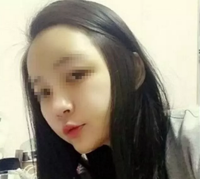 南充华美自体脂肪祛黑眼圈+脂肪填充全面部恢复过程及对比照分享 案例图2
