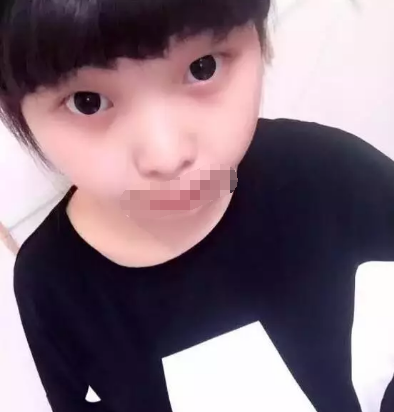 6张照片揭秘我在南充五星做全切双眼皮从术前到恢复的全过程