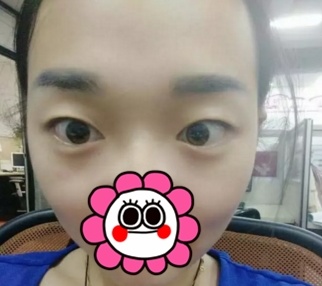 本想去运城华美割双眼皮，没想到陈先才要我做眼综合整形美呆了