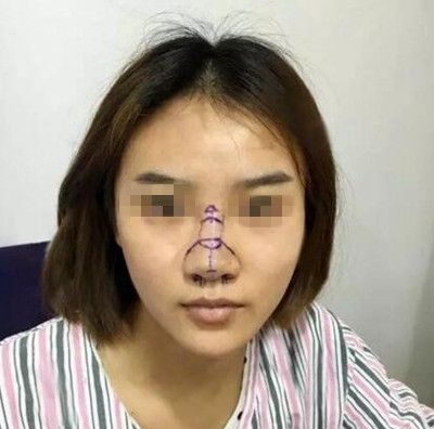 记录我在南阳艾美花32800元做鼻综合手术后恢复2个月的全过程