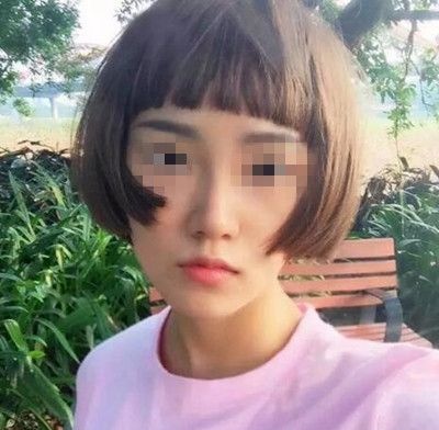 记录我在南阳艾美花32800元做鼻综合手术后恢复2个月的全过程 图2