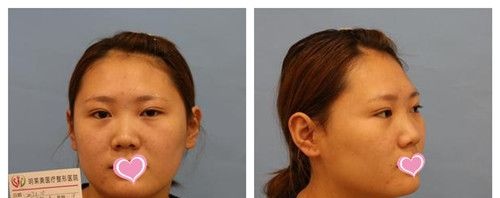 宛若天生的耳软骨复合隆鼻效果我只服承德玥莱美孙喜平医生