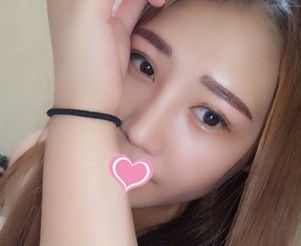 宛若天生的耳软骨复合隆鼻效果我只服承德玥莱美孙喜平医生 图2