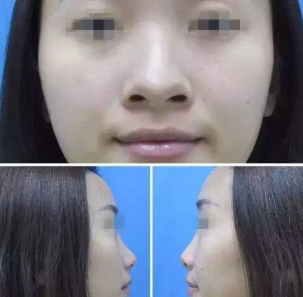 思来想去还是到沧州静港找季泽东做了达拉斯综合隆鼻 没想到效果如此惊人