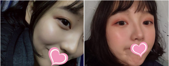 分享我在潍坊华美医院找任传琦做的硅胶假体隆鼻手术恢复日记 图2
