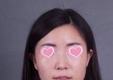20天自然美鼻效果秀出来 只因在邢台博爱采用射极峰膨体做鼻综合整形太靠谱