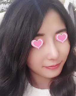 20天自然美鼻效果秀出来 只因在邢台博爱采用射极峰膨体做鼻综合整形太靠谱 图2