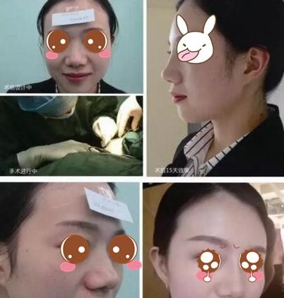 信阳东方艺定制鼻整形让她们面部立体焕新颜