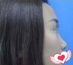 看我找海口鹏爱张淑艳做的鼻综合一个月后，侧颜挺挺的线条感超强