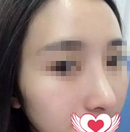 看我找海口鹏爱张淑艳做的鼻综合一个月后,侧颜挺挺的线条感超强 图2