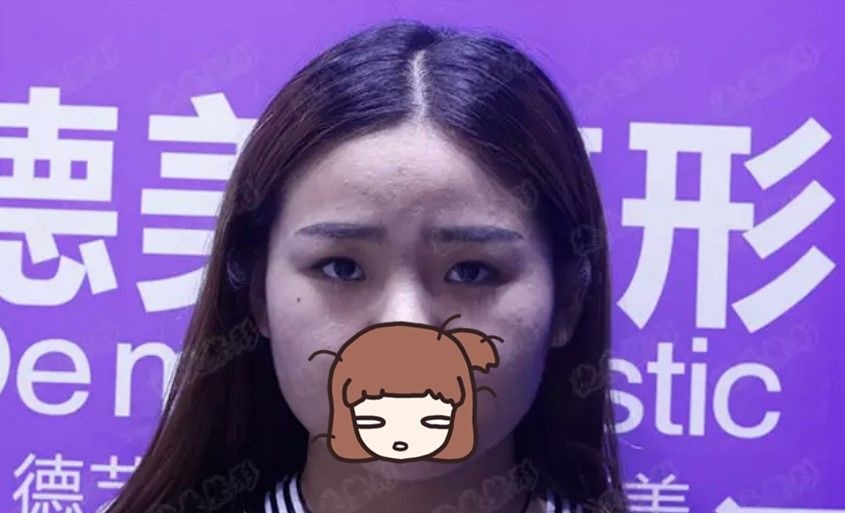 看我找常德德美整形李倩做的双眼皮+开眼角20天后变化大吗?