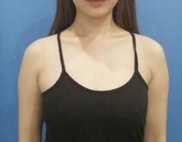 找海南华美整形王武做假体隆胸之后，我终于做回真正的女人！