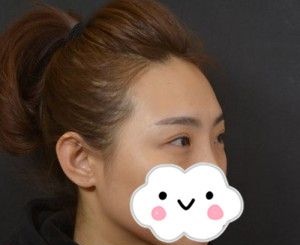 佳木斯韩艺来医疗美容医院谷永安医生让我重新拥有了美丽的眼睛
