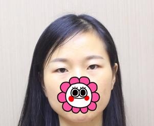 宜昌前卫李传荣院长切开双眼皮+开内眼角1个月恢复详情报告