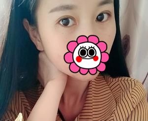 宜昌前卫李传荣院长切开双眼皮+开内眼角1个月恢复详情报告 图2