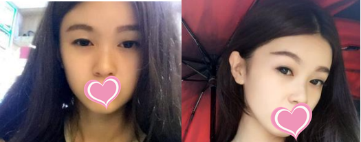 菏泽华美做双眼皮手术比较厉害,并且收费价格也能接受
