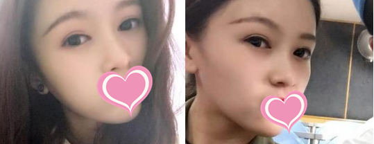 菏泽华美做双眼皮手术比较厉害,并且收费价格也能接受 图2