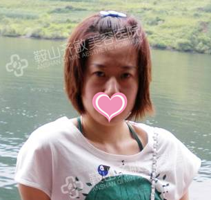 在鞍山齐敏整形医院做完玻尿酸填充面部后,我成功蜕变成美丽新娘