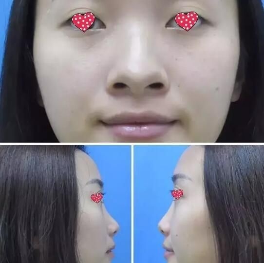 大而圆的鼻头外加低鼻梁在宿迁天黛做达拉斯综合隆鼻蜕变历程