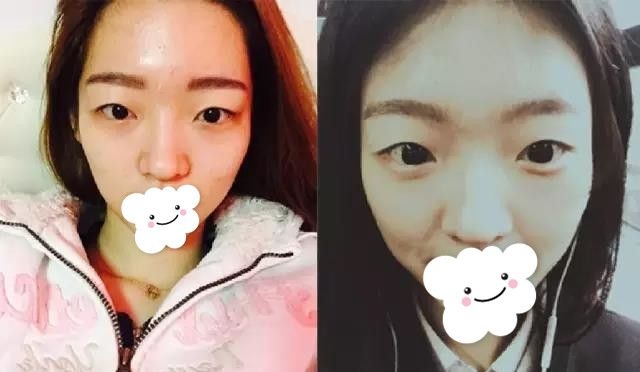 她找盐城东方王武坤做完双眼皮+鼻综合，1个月后竟变成这个样子