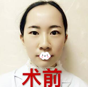 找河源华美整形医院何为院长做完全切双眼皮后整个人都变得自信了