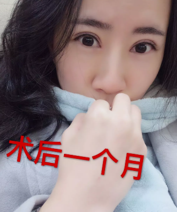 找河源华美整形医院何为院长做完全切双眼皮后整个人都变得自信了 图2