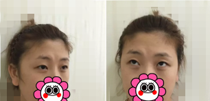 看了我找锦州斯美诺整形周杰做的双眼皮修复后闺蜜也迫不及待想要同款了