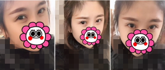 看了我找锦州斯美诺整形周杰做的双眼皮修复后闺蜜也迫不及待想要同款了 图2