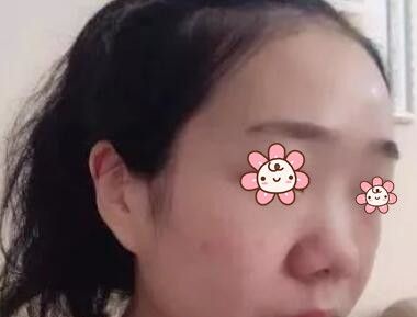 跑了趟新疆黎美整形做耳软骨隆鼻+垫鼻尖+鼻翼缩小 搞得我都惊呆了！