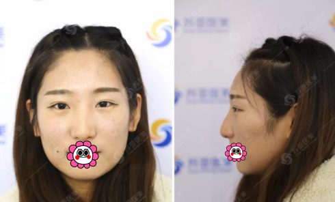 仅1个月从土妞逆袭气质女神 庆幸自己在唐山美联臣做了眼鼻综合整形