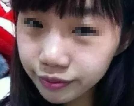 到扬州美贝尔做了假体隆鼻+面部脂肪填充后居然改善了我的塌鼻子和凸嘴巴