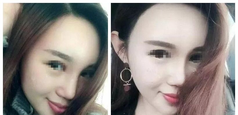 到扬州美贝尔做了假体隆鼻+面部脂肪填充后居然改善了我的塌鼻子和凸嘴巴 图2