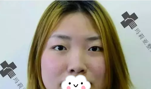 分享宜宾玛莉亚内部员工鼻综合术后对比图 见证女神的诞生