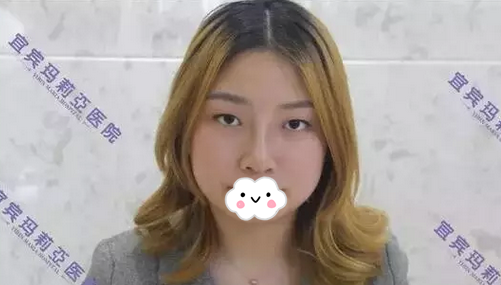 分享宜宾玛莉亚内部员工鼻综合术后对比图 见证女神的诞生 图2