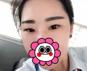 想看宜昌伊莱美整形案例?那医生刘志兵为我做的切开双眼皮你喜欢不