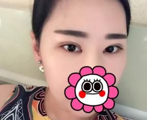 想看宜昌伊莱美整形案例?那医生刘志兵为我做的切开双眼皮你喜欢不 图2